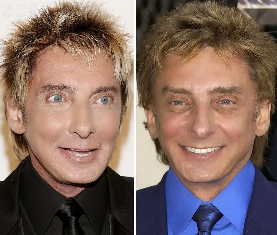 Barry Manilow Before And After